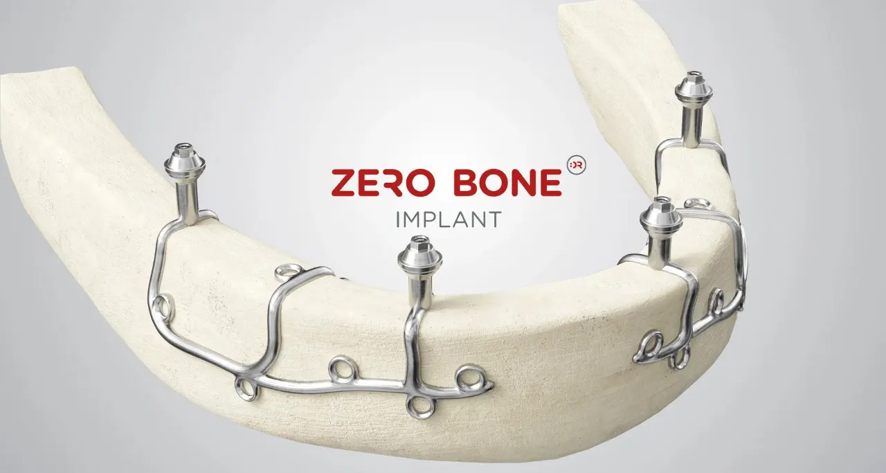 Subperiostale Implantate - Zero Bone Implant Koncept | Štimac centar dentalne medicine