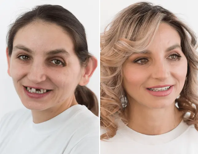 Zahnkronen | Dental crowns | Rezultati krunice #1