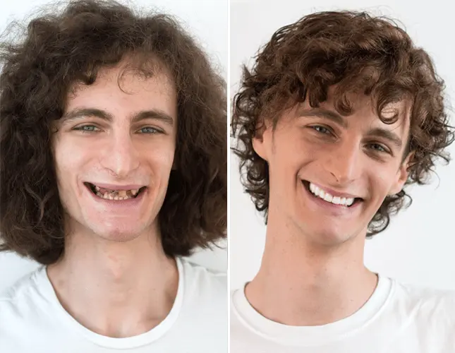 Zahnkronen | Dental crowns | Rezultati krunice #2