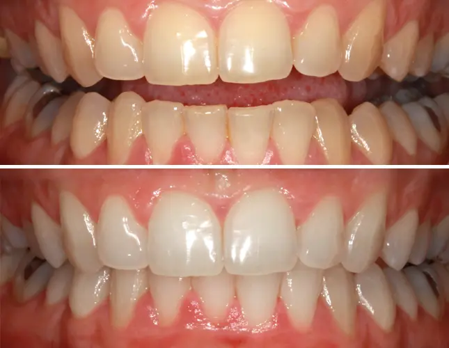 Zahnaufhellung | Izbjeljivanje zubi | Štimac centar dentalne medicine