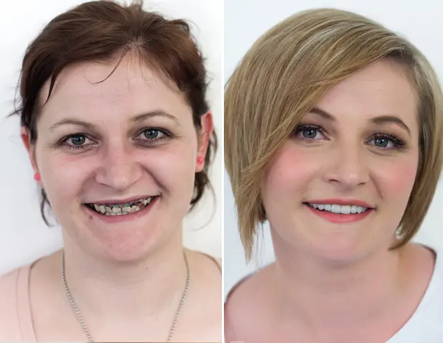 Zahnveneers | Dental veneers | Rezultati implantati #2