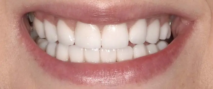 Fallstudien | Case studies | Before and after 2 | Before and after | Slučaj ugradnje ljuskica i krunica