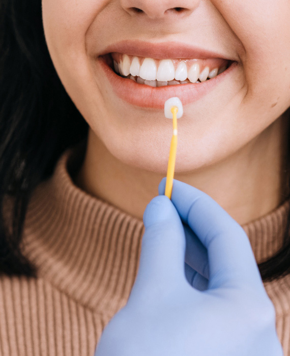 Zahnveneers | Dental veneers | Ljuskice za zube - Veneers | Cijena | Štimac Centar dentalne medicine | Ljuskice za zube | Stomatološka poliklinika Zagreb | Štimac centar dentalne medicine