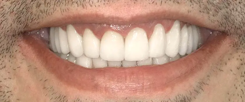 Fallstudien | Case studies | Before and after 2 | Before and after | Slučaj ugradnje implantata, mostova i krunica