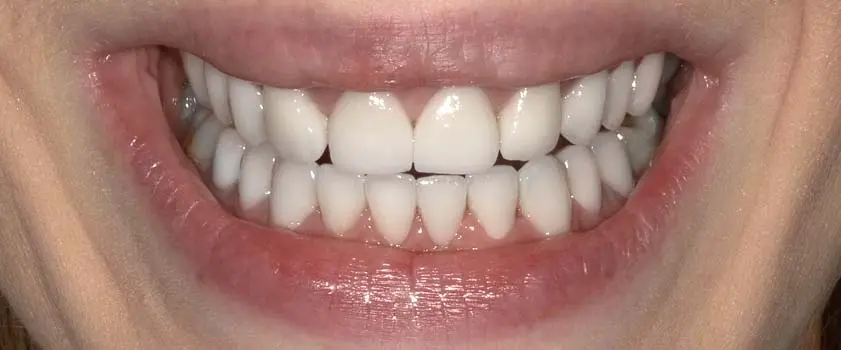 Fallstudien | Case studies | Before and after 2 | Before and after | Slučaj ugradnje ljuskica i krunica