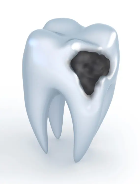 Zahnfüllungen | Fillings | Što je zubni karijes | Štimac centar dentalne medicine