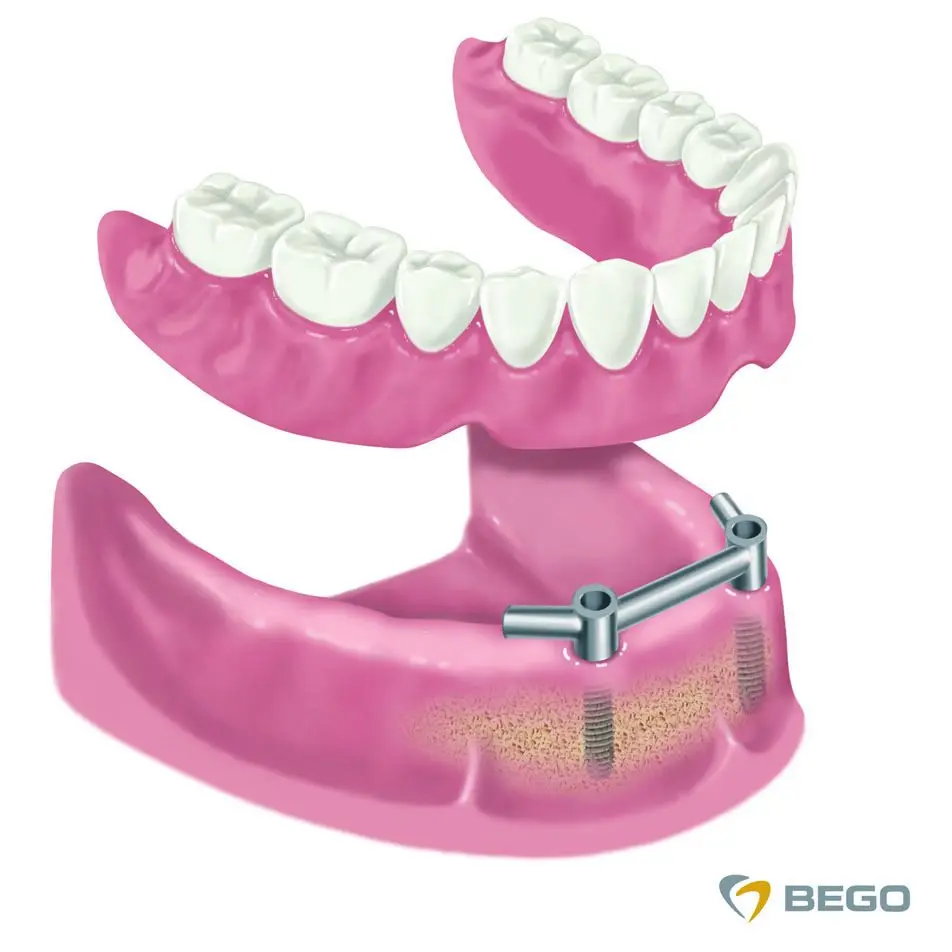 Zahnprothetik | LJUSKICE ZA ZUBE
