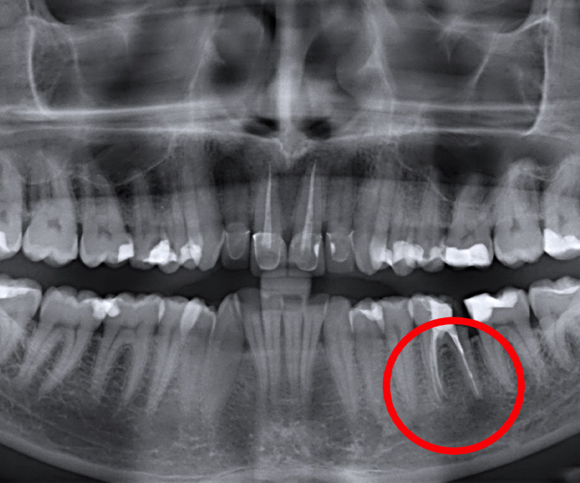 Oralchirurgie | ZAHVAT APIKOTOMIJE