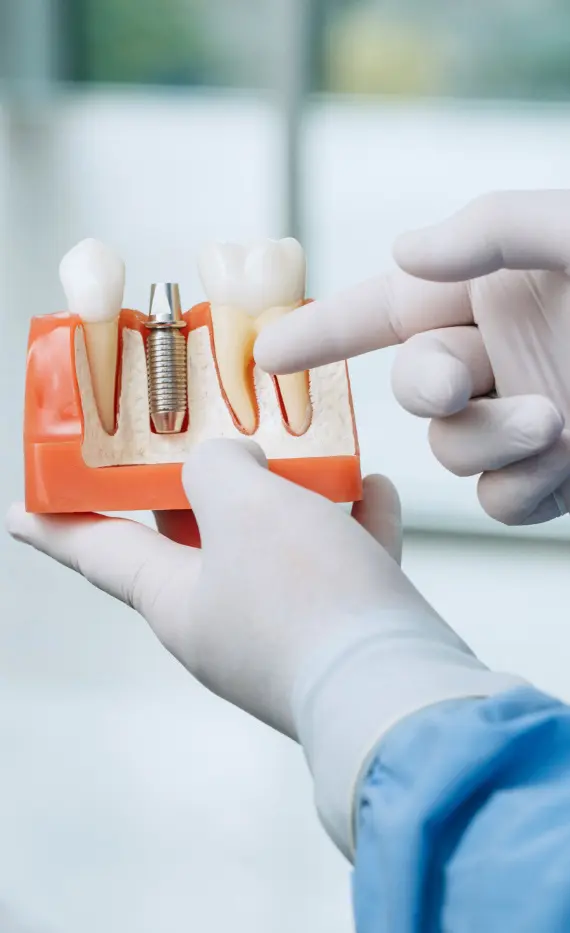 Zahnimplantate | Dental implants | SAVRŠENE I PUNE USNE?