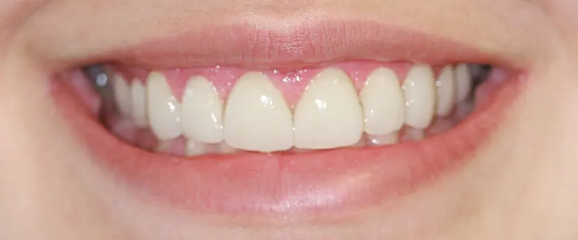 Fallstudien | Case studies | Before and after 2 | Before and after | PORCULANSKE LJUSKICE ZA ZUBE