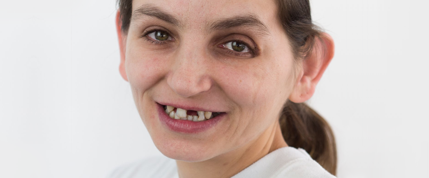 Makeover | Dental makeover | Slučaj ugradnje ljuskica i krunica