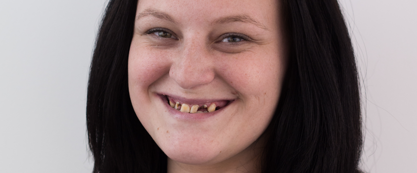 Makeover | Dental makeover | ZUBNE KRUNICE