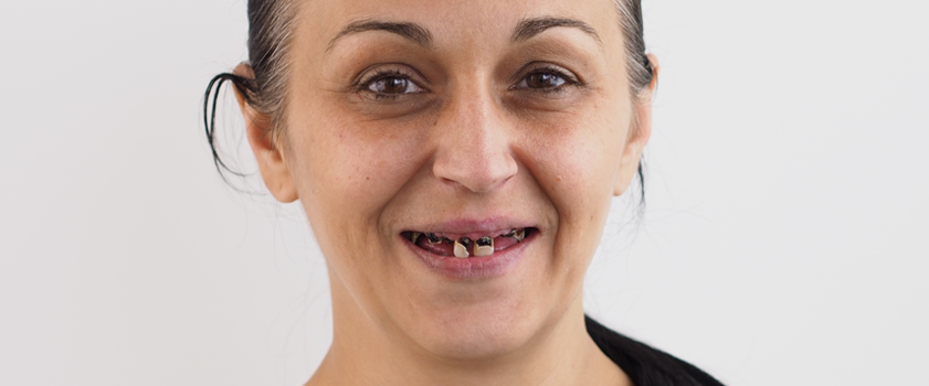 Makeover | Dental makeover | ZUBNI MOSTOVI