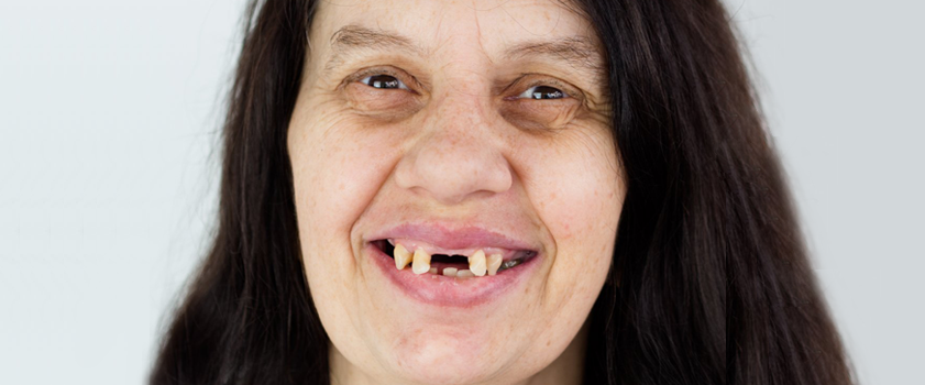 Makeover | Dental makeover | Slučaj ugradnje ljuskica i krunica