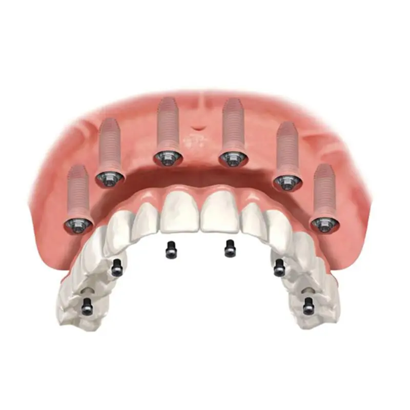 Do You Know All the Ways an Edentulous Jaw Can Be Treated? | Znate li kako sve možete riješiti problem bezube čeljusti? - | Znate li kako sve možete riješiti problem bezube čeljusti? | Stomatološka poliklinika Zagreb | Štimac centar dentalne medicine