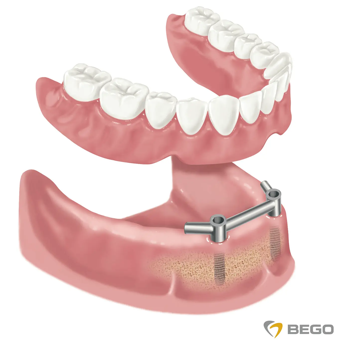 Do You Know All the Ways an Edentulous Jaw Can Be Treated? | Znate li kako sve možete riješiti problem bezube čeljusti? - | Znate li kako sve možete riješiti problem bezube čeljusti? | Stomatološka poliklinika Zagreb | Štimac centar dentalne medicine