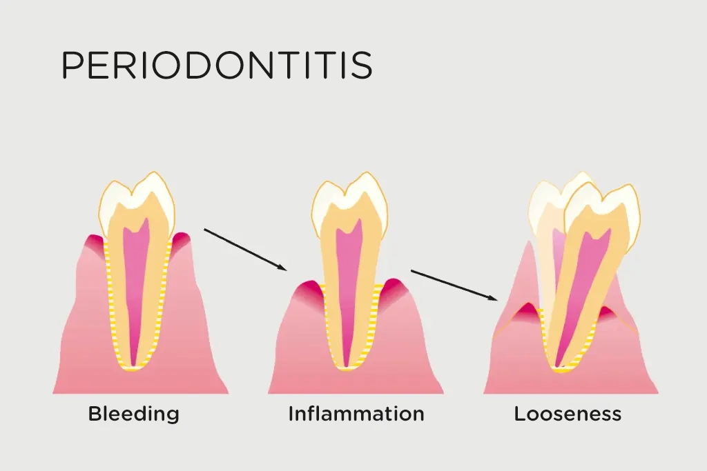 Bad Breath, a Strange Taste in the Mouth, and Bleeding Gums – One of the Most Common Gum Diseases May Be Behind Them | Stomatološka poliklinika Zagreb | Štimac centar dentalne medicine