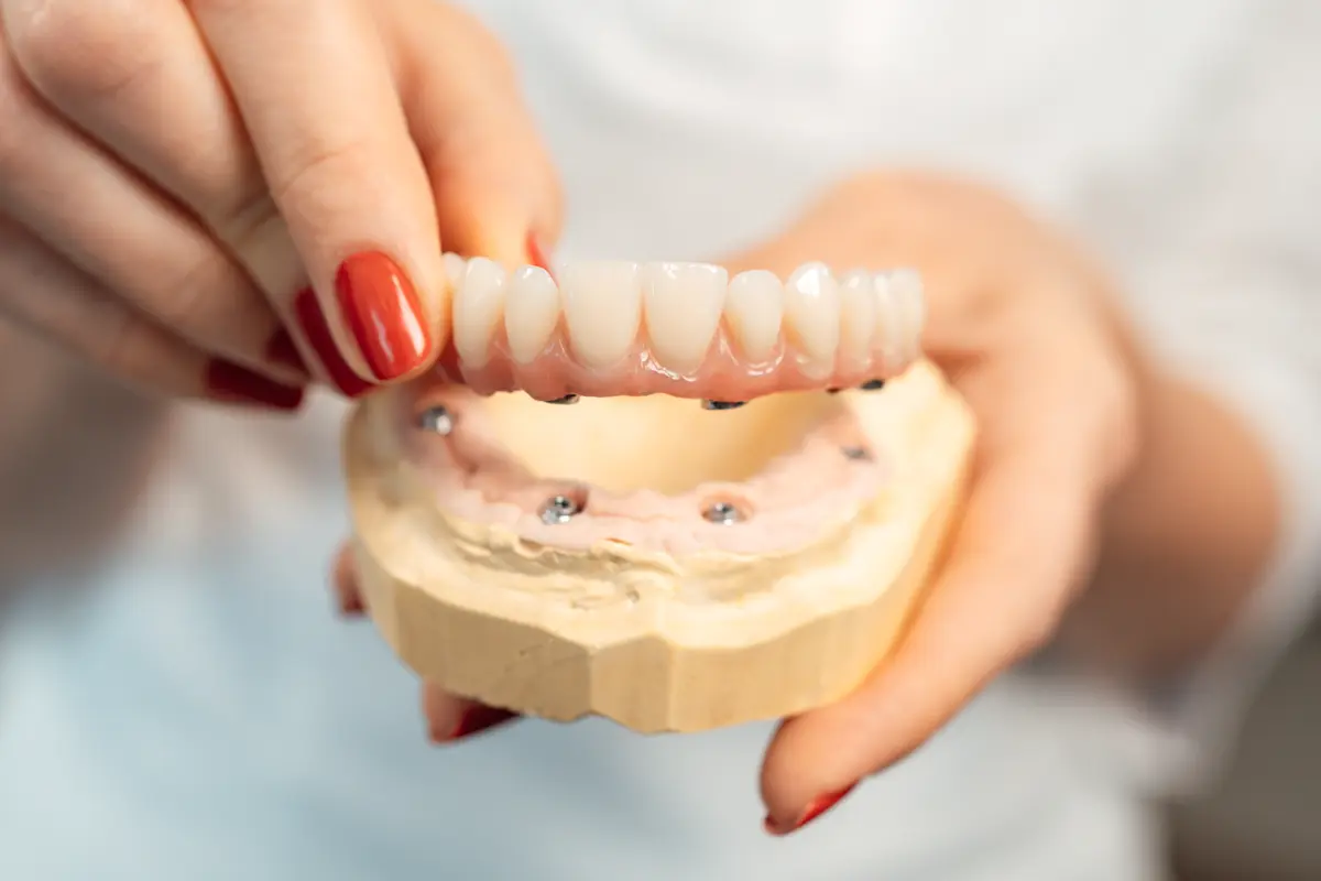 Everything You Wanted to Know About the All-on-4 Method | Stomatološka poliklinika Zagreb | Štimac centar dentalne medicine