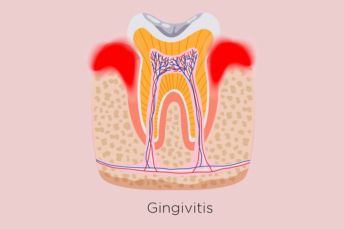 Everything You Need to Know About Gum Disease and How to Treat It | Sve što trebate znati o bolestima zubnog mesa te kako ih liječiti | Sve što trebate znati o bolestima zubnog mesa i kako ih liječiti | Što napraviti kad vas boli zub - sve što trebate znati o upali zuba | sve što trebate znati o upali zuba