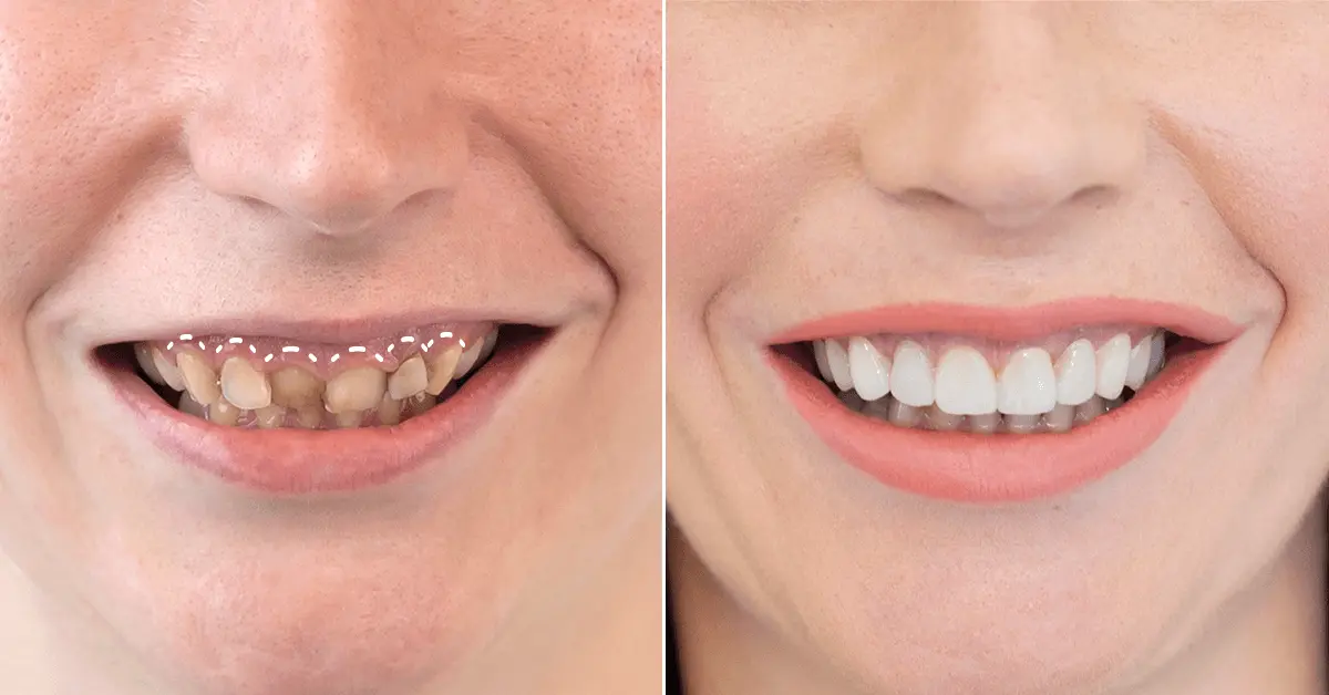 Mission: A Hollywood Smile | Misija: hollywoodski osmijeh - Stomatološka poliklinika | Misija: hollywoodski osmijeh | Stomatološka poliklinika Zagreb | Štimac centar dentalne medicine