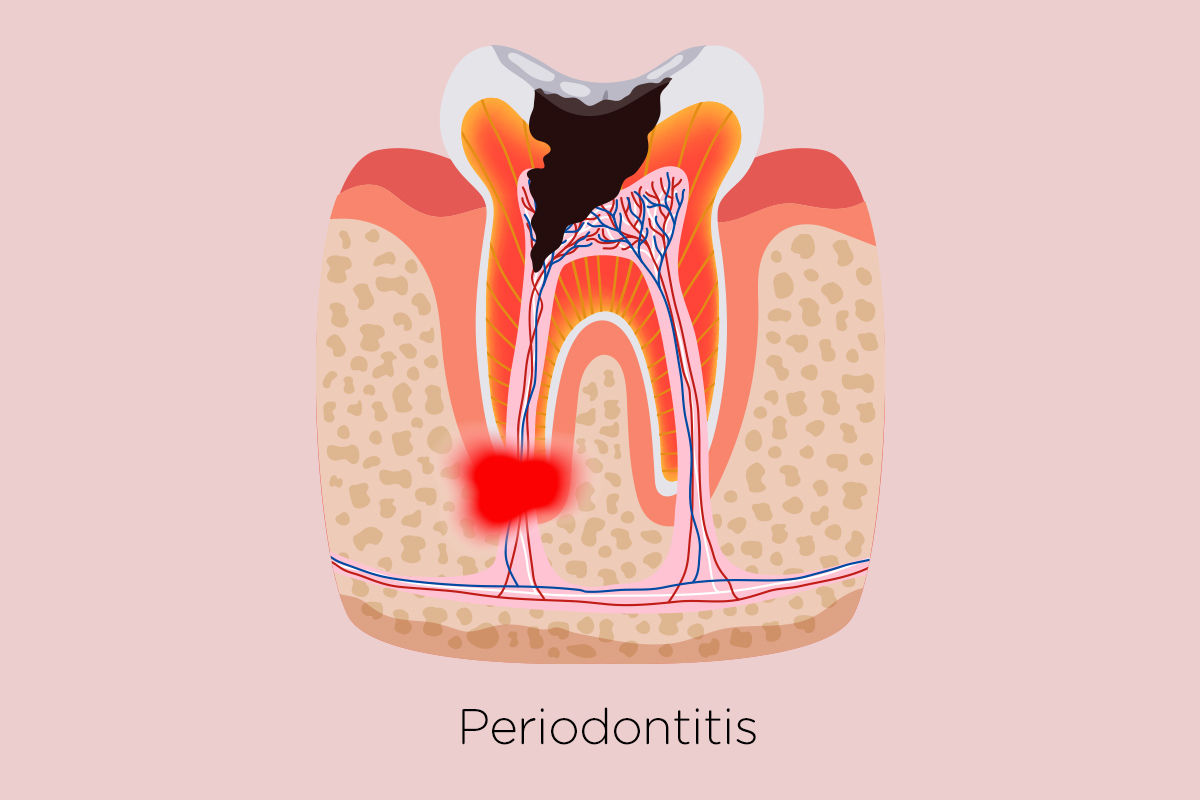 Everything You Need to Know About Gum Disease and How to Treat It | Sve što trebate znati o bolestima zubnog mesa te kako ih liječiti | Sve što trebate znati o bolestima zubnog mesa i kako ih liječiti | Što napraviti kad vas boli zub - sve što trebate znati o upali zuba | Stomatološka poliklinika Zagreb | Štimac centar dentalne medicine