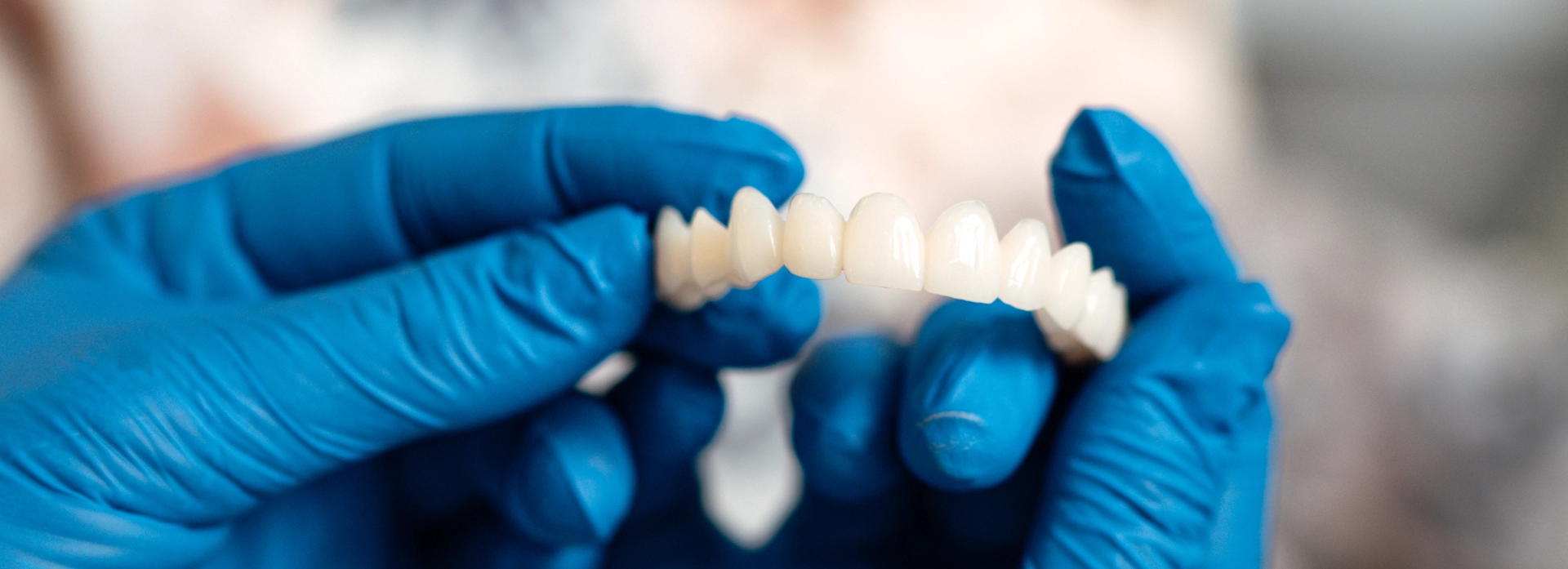 Everything You Wanted to Know About Dental Crowns and Bridges - Stomatološka poliklinika Zagreb | Štimac centar dentalne medicine