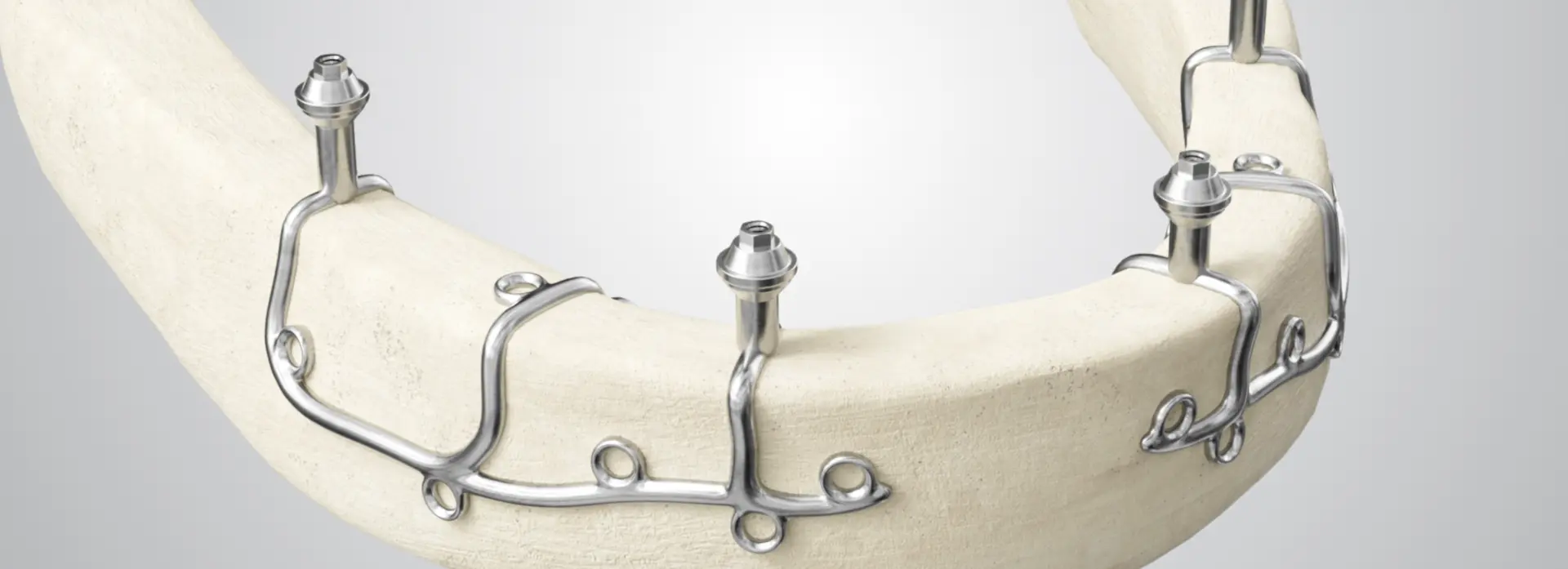 A Revolutionary Solution for Everyone Who Until Now Could Not Get Implants - Zero Bone Implant | Štimac centar dentalne medicine