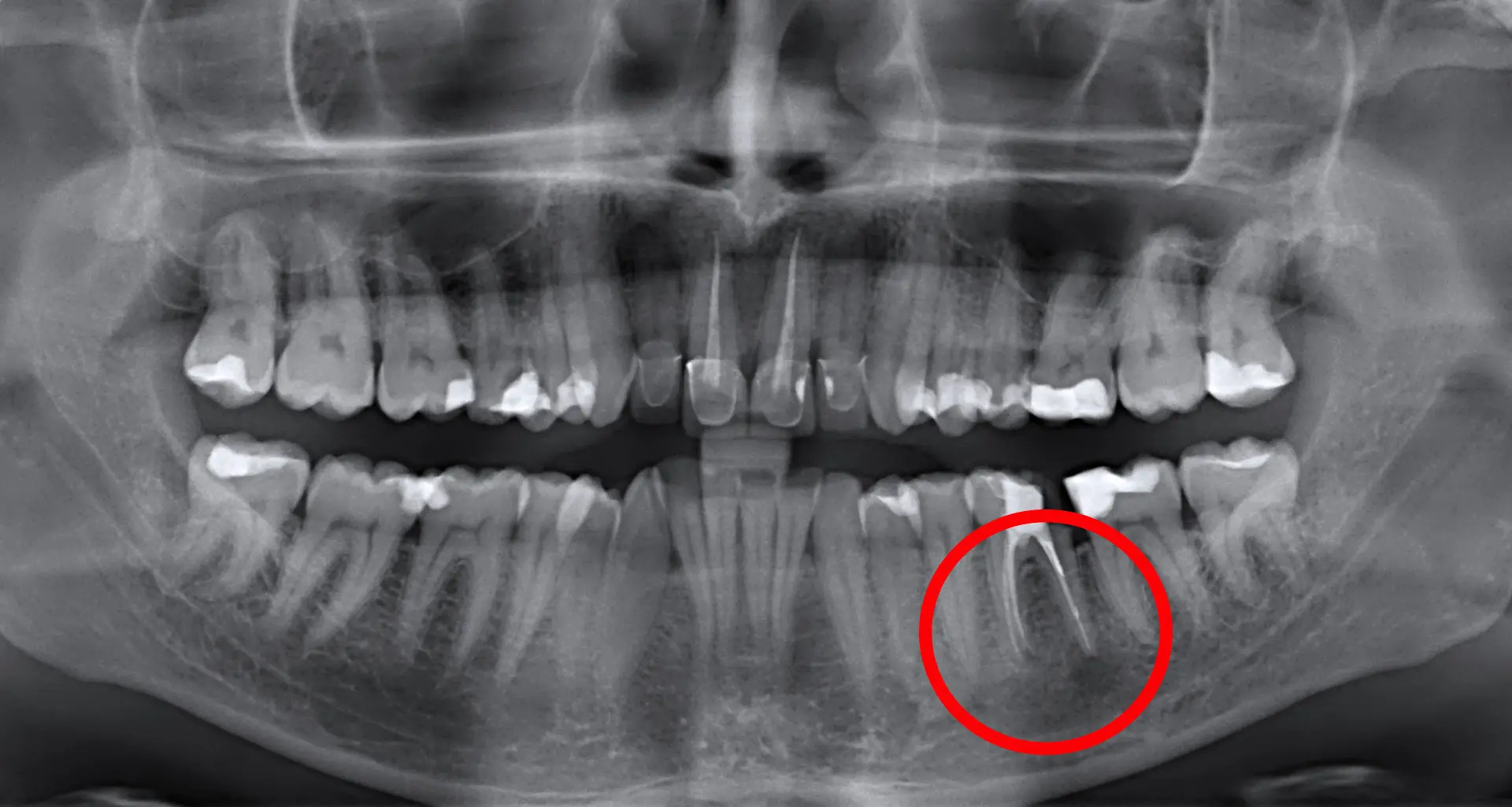 Apicoectomy – the surgical removal of the top of the root - Apikotomija - kirurško odstranjenje vrška korijena | Štimac centar dentalne medicine