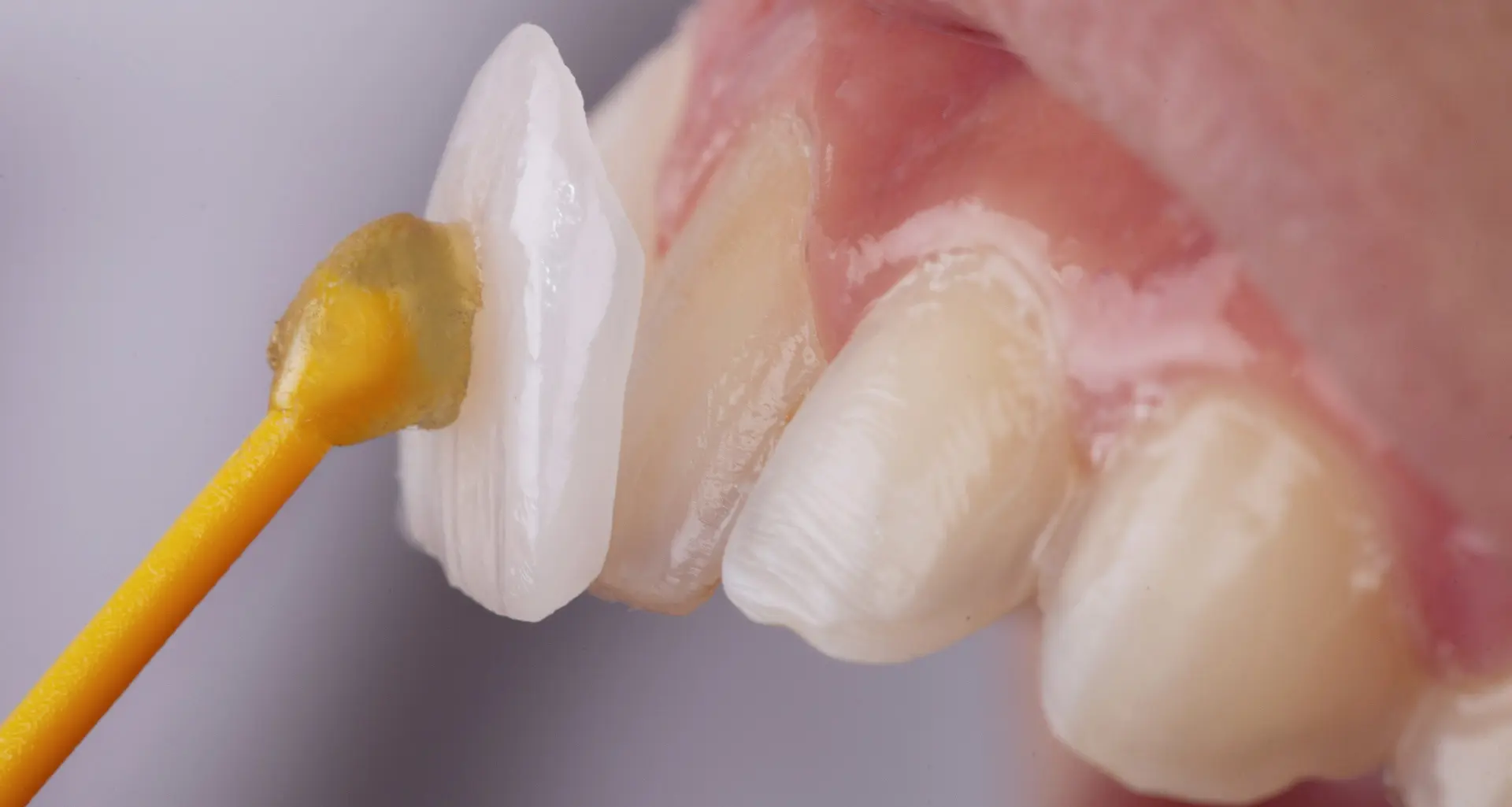 Dental prosthetics - Zubna protetika | Štimac centar dentalne medicine