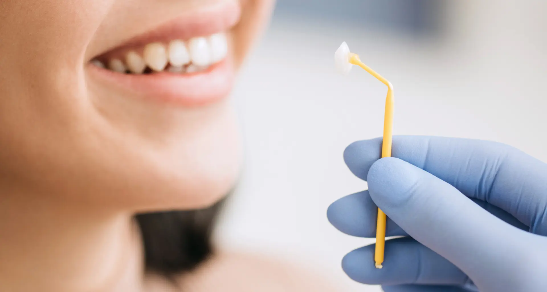 Dental veneers - Ljuskice za zube | Štimac centar dentalne medicine