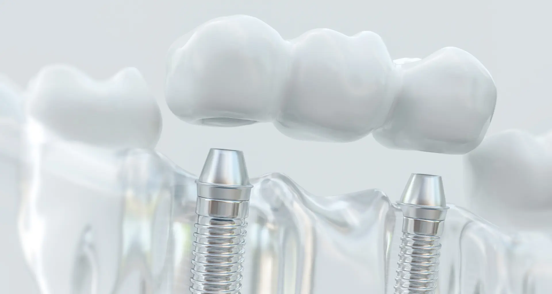 Dental implants - Zubni implantati | Štimac centar dentalne medicine