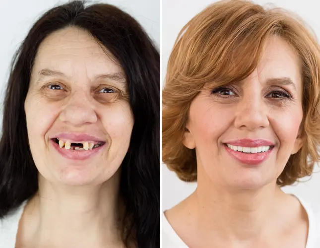 Dental implants | Rezultati implantati #2