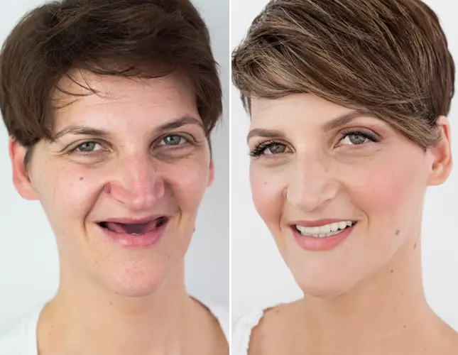 All-on-4 | Rezultati implantati #2