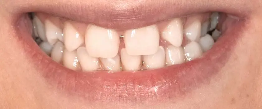 Case studies | Before and after 2 | Before and after | Slučaj ugradnje ljuskica i krunica