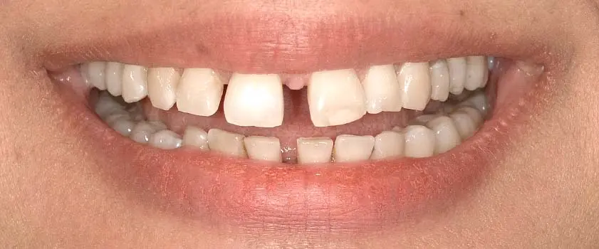 Case studies | Before and after 2 | Before and after | Slučaj ugradnje ljuskica i krunica