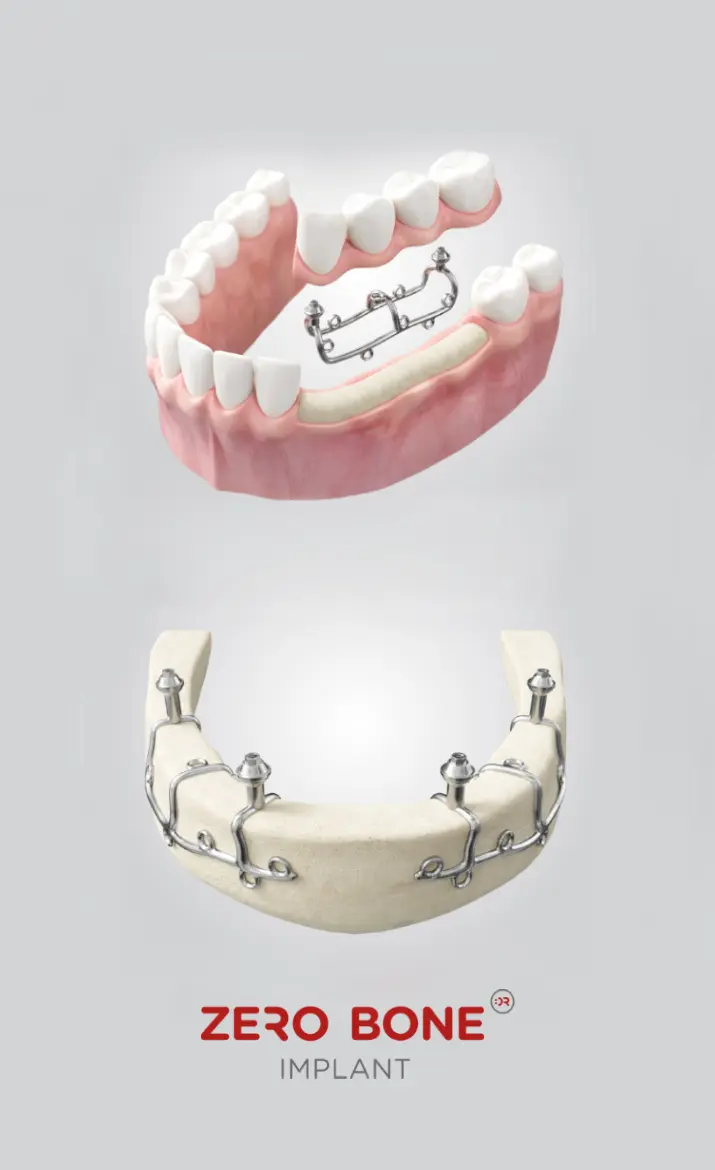 Subperiosteal Implants | Zero Bone Implant Concept | Subperiostalni implantati | Štimac Centar dentalne medicine | Subperiostalni implantati | Zero Bone Implant Koncept Štimac centar dentalne medicine