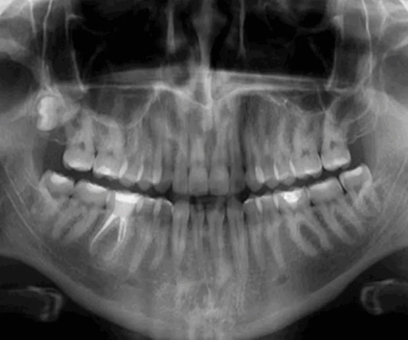 Cystectomy | SAVRŠENE I PUNE USNE?