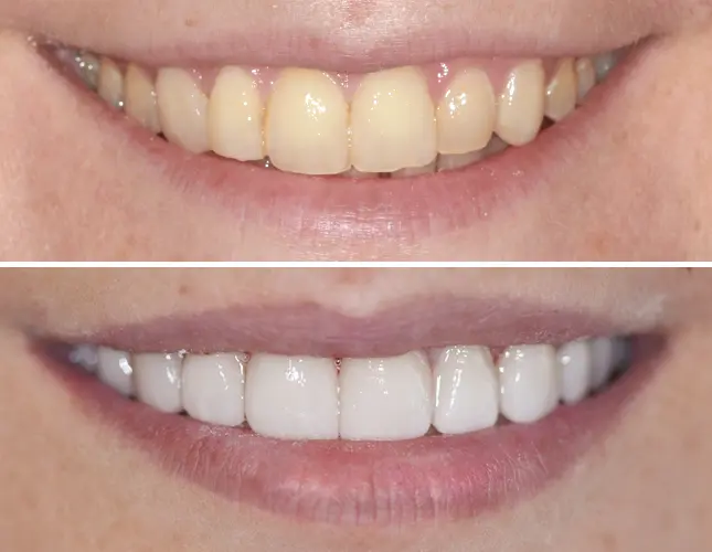 Teeth whitening | Rezultati mostovi #1