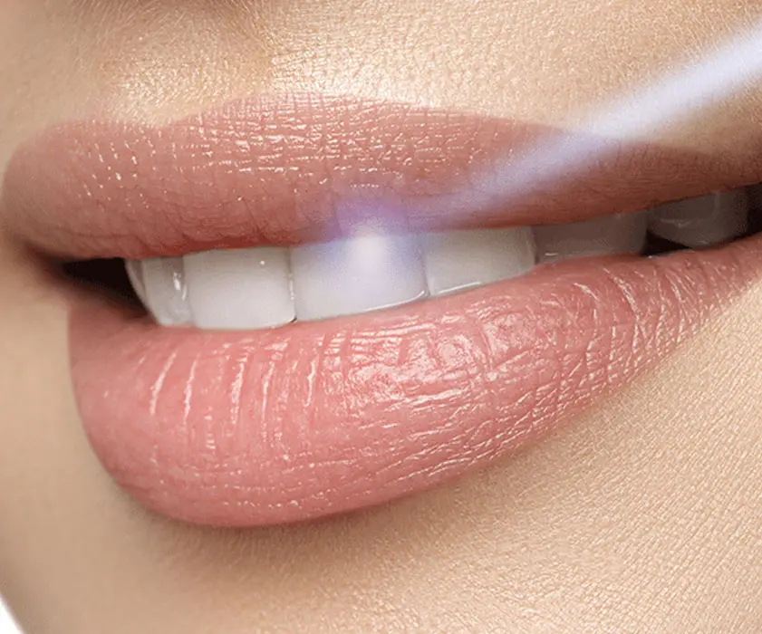 Teeth whitening | IZBJELJIVANJE ZOOM LAMPOM