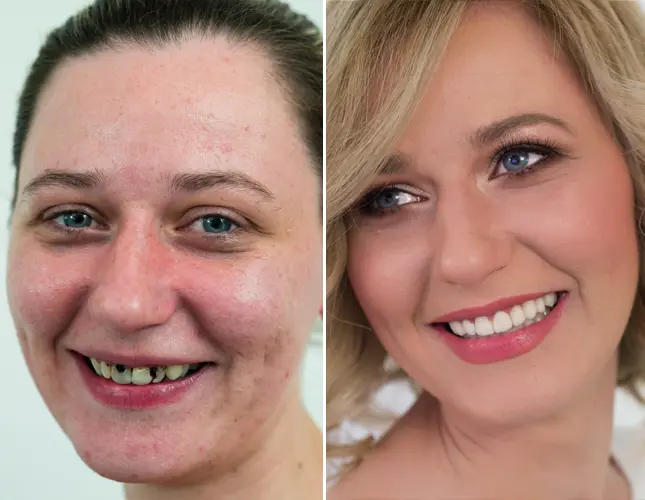 Dental veneers | Rezultati implantati #2
