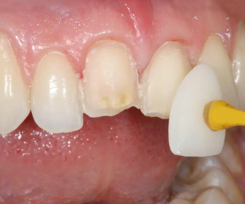 Dental laboratory | LJUSKICE ZA ZUBE