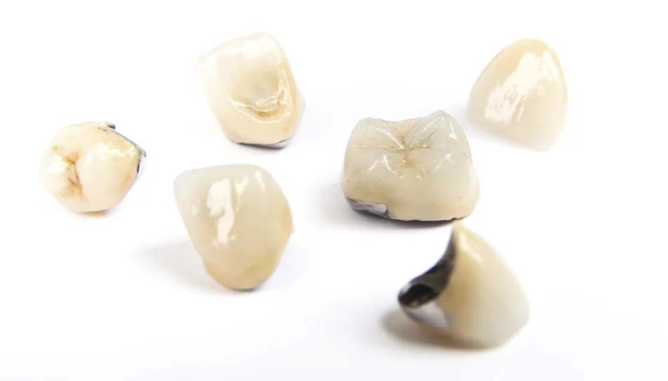 Dental crowns | METAL-KERAMIČKA ZUBNA KRUNICA