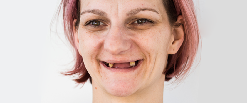 Dental makeover | Slučaj ugradnje implantata, mostova i krunica