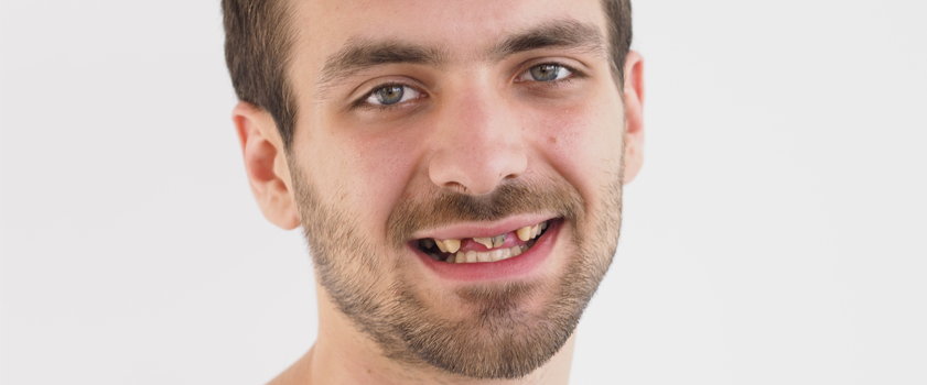 Dental makeover | IMPLANTATI