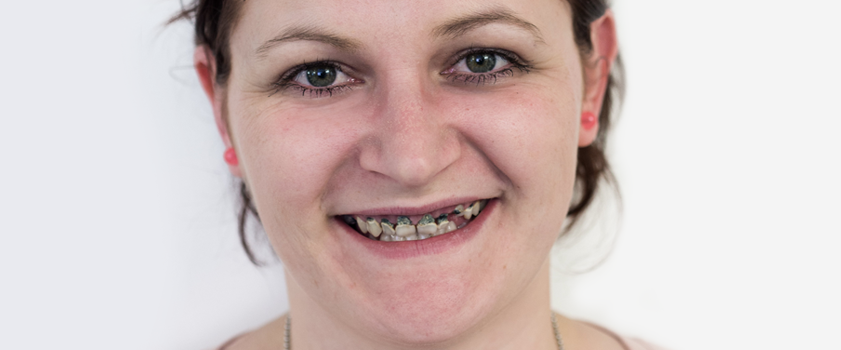 Dental makeover | PORCULANSKE LJUSKICE ZA ZUBE