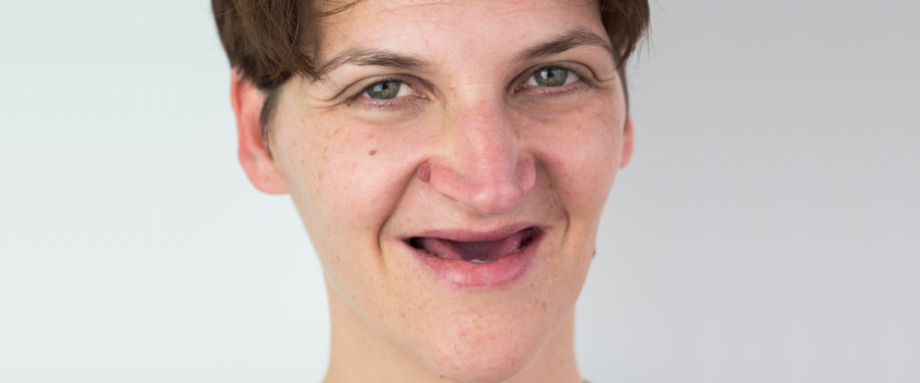 Dental makeover | Slučaj ugradnje ljuskica i krunica