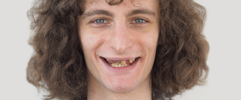 Dental makeover | Slučaj ugradnje ljuskica i krunica