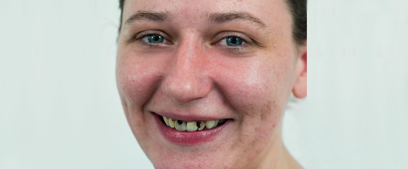 Dental makeover | IZBJELJIVANJE ZUBI