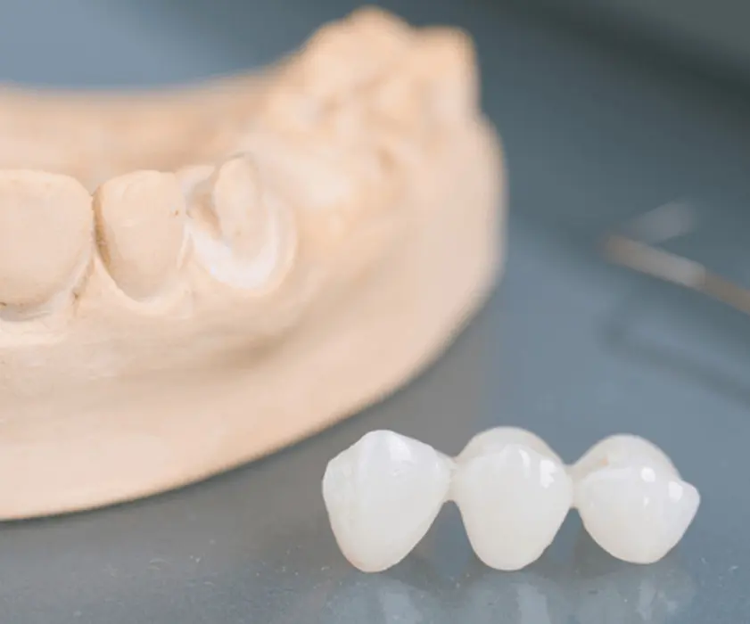 Dental prosthetics | ZUBNI MOSTOVI