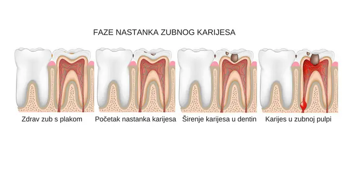 Što su zubne plombe | Štimac Centar dentalne medicine | Što su zubne plombe (zubni ispuni)? | Stomatološka poliklinika Zagreb | Štimac centar dentalne medicine